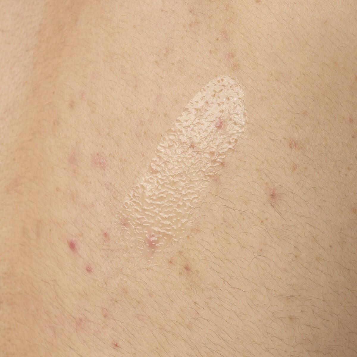 salicylic-acid-0-5-body-serum-t8 ORD-salicylic-acid-05-body-240ml-application.jpg