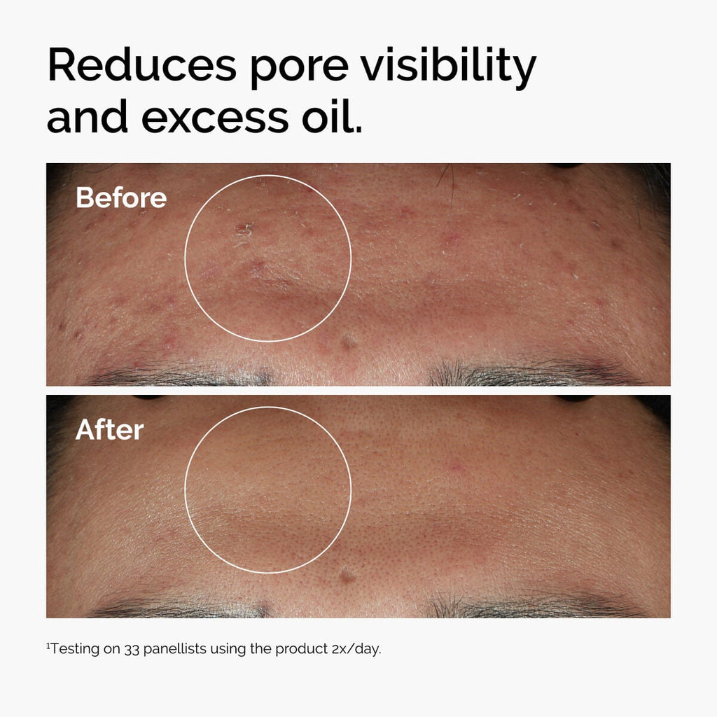 niacinamide-10-zinc-1-e5 ord-niacinamide-zinc-blemish-serum-before-after-pores.jpg