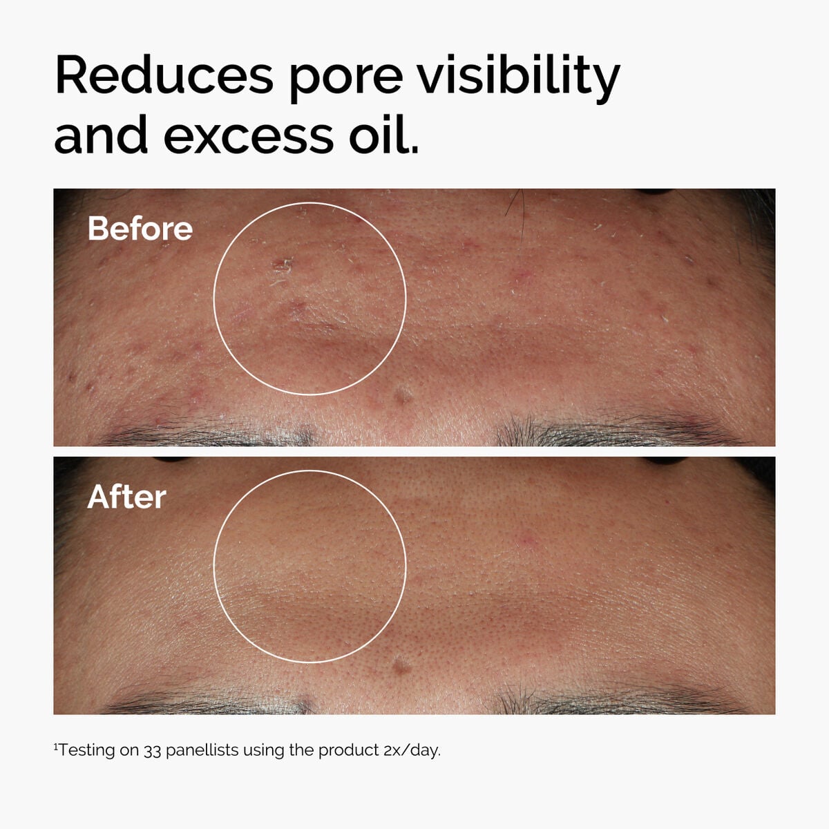 niacinamide-10-zinc-1-e5 ord-niacinamide-zinc-blemish-serum-before-after-pores.jpg
