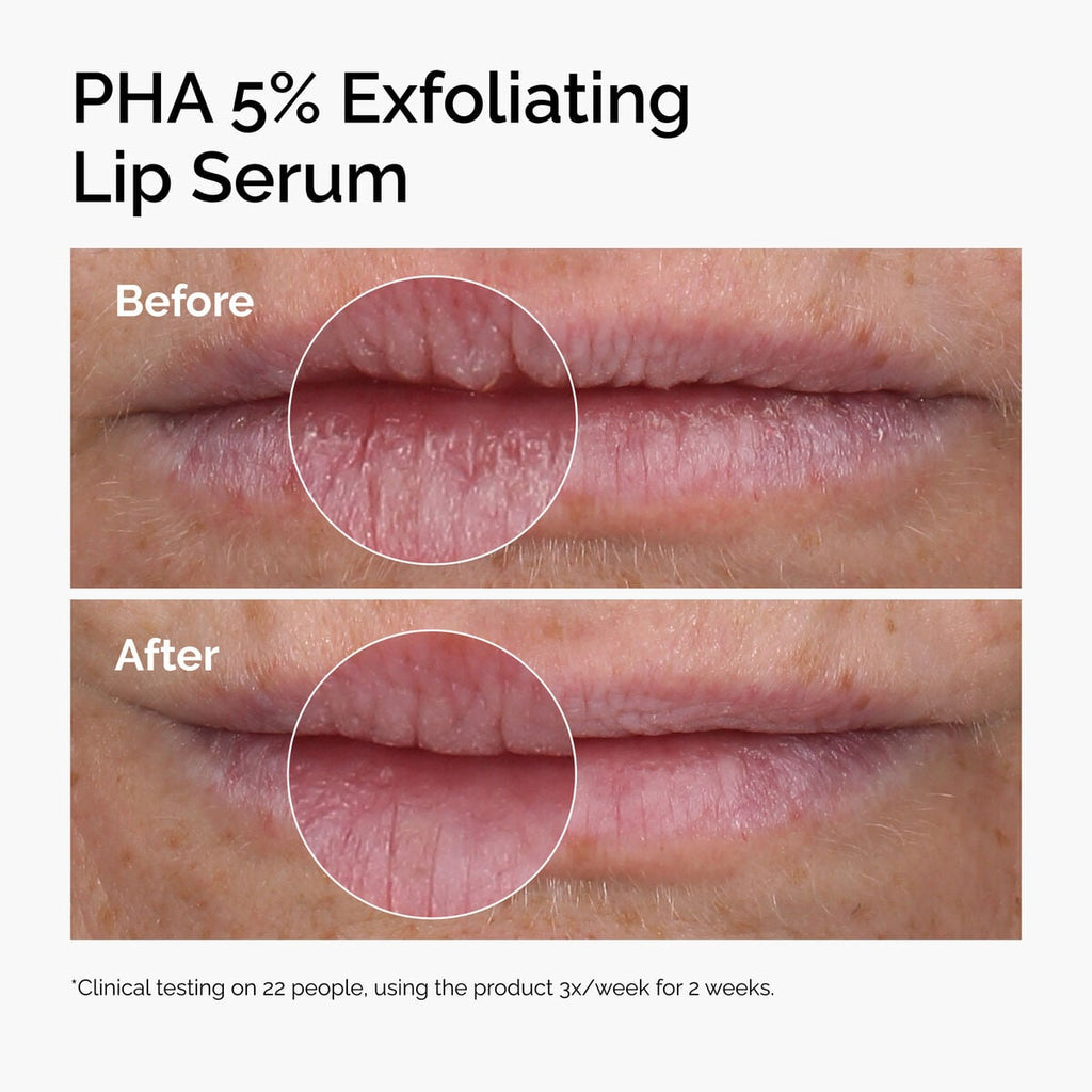 pha-5-exfoliating-lip-serum-r5 ord-pha-5pct-lip-exfoliating-serum-before-after.jpg