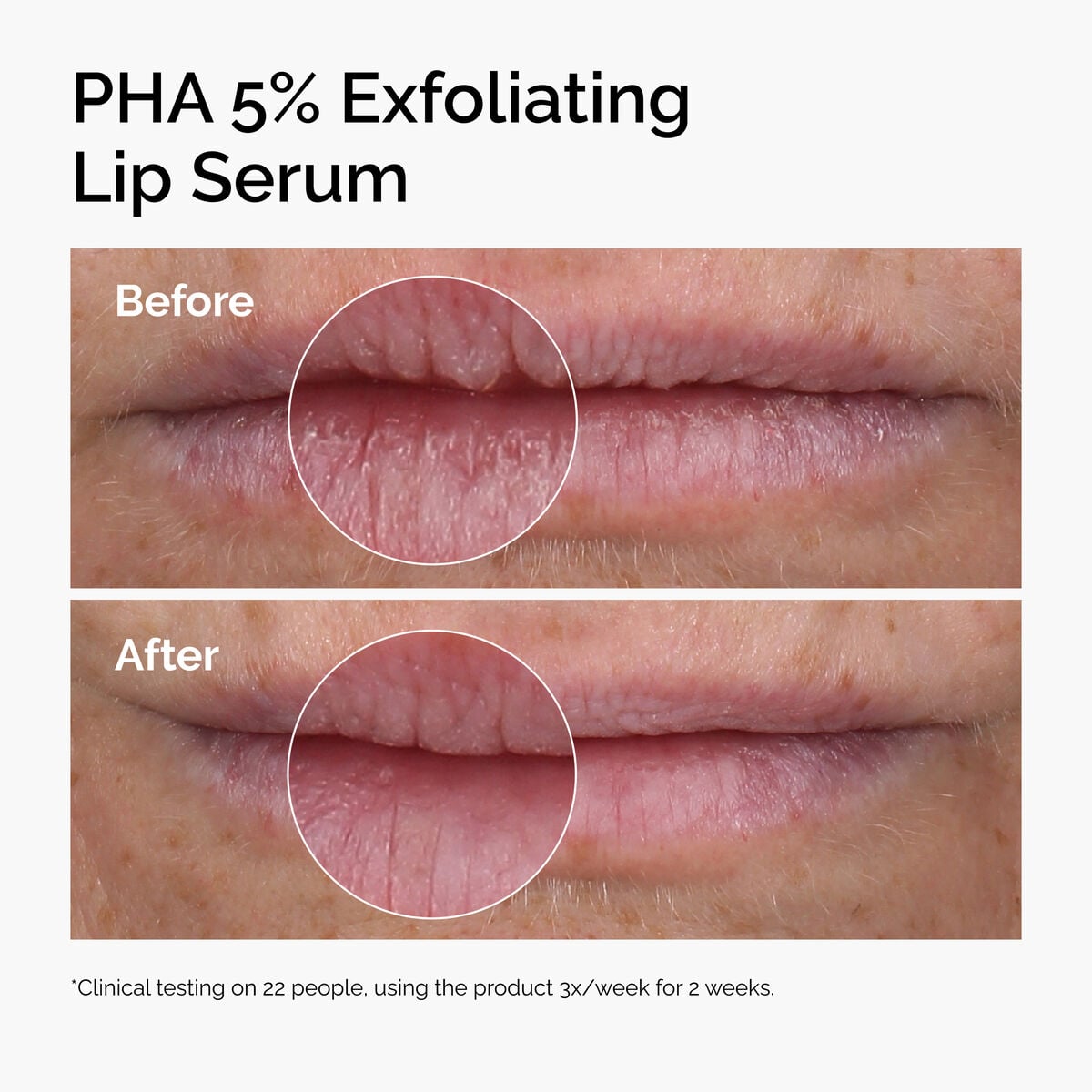 pha-5-exfoliating-lip-serum-r5 ord-pha-5pct-lip-exfoliating-serum-before-after.jpg