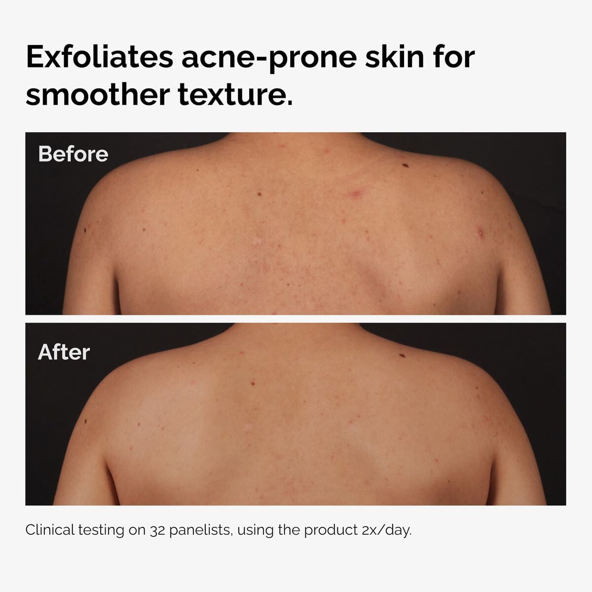 salicylic-acid-0-5-body-serum-t8 ord-salicylic-acid-body-serum-before-after-graphic-NA.jpg
