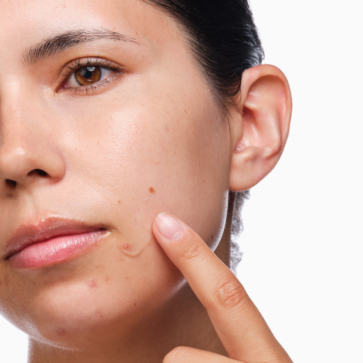 the-acne-set-k4 rdn-the-acne-set-application.png